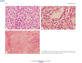784 Patología especial
FIGURA 23-32. Espectro microscópico de los tumores germinales. a) Germinoma intracra-
neano. b) Tumor de saco vitelino en testículo. c) Teratoma inmaduro con mezcla de tejidos
bien diferenciados alternando con neuroepitelio primitivo.
(a) (b)
(c)
© 2007 Editorial Médica Panamericana, S.A de C.V.
Cisfarm
 