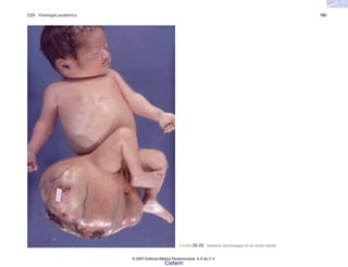 C23 Patología pediátrica 785
FIGURA 23-33. Teratoma sacrocoxígeo en un recién nacido.
© 2007 Editorial Médica Panamericana, S.A de C.V.
Cisfarm
 