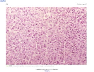 786 Patología especial
FIGURA 23-34. Histocitosis X. Las células de Langerhans muestran núcleos estriados y abundante citoplasma.
© 2007 Editorial Médica Panamericana, S.A de C.V.
Cisfarm
 