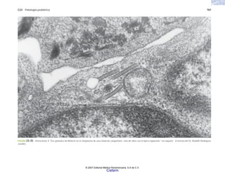 C23 Patología pediátrica 787
FIGURA 23-35. Histocitosis X. Tres gránulos de Birbeck en el citoplasma de una célula de Langerhans. Uno de ellos con la típica expansión “en raqueta”. (Cortesía del Dr. Rodolfo Rodríguez
Jurado).
© 2007 Editorial Médica Panamericana, S.A de C.V.
Cisfarm
 