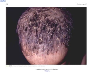 788 Patología especial
FIGURA 23-36. Histocitosis X tipo Letterer Siwe con afección seboreica de piel de cráneo.
© 2007 Editorial Médica Panamericana, S.A de C.V.
Cisfarm
 