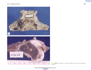 C23 Patología pediátrica 789
FIGURA 23-37. Histocitosis X. Lesiones osteoliticas. (a) en peñasco temporal (b)
en fémur.
(a)
(b)
© 2007 Editorial Médica Panamericana, S.A de C.V.
Cisfarm
 