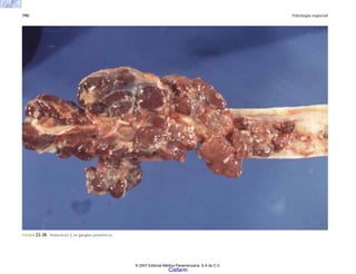 790 Patología especial
FIGURA 23-38. Histocitosis X en ganglios periaórticos.
© 2007 Editorial Médica Panamericana, S.A de C.V.
Cisfarm
 