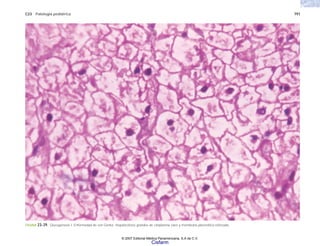 C23 Patología pediátrica 791
FIGURA 23-39. Glucogenosis I. Enfermedad de von Gierke. Hepatocitosis grandes de citoplasma claro y membrana plasmática reforzada.
© 2007 Editorial Médica Panamericana, S.A de C.V.
Cisfarm
 