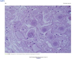 792 Patología especial
FIGURA 23-40. Glucogenosis II. Enfermedad de Pompe. Acumulación de glucógeno en neuronas.
© 2007 Editorial Médica Panamericana, S.A de C.V.
Cisfarm
 