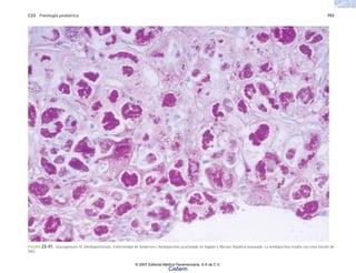 C23 Patología pediátrica 793
FIGURA 23-41. Glucogenosis IV. (Amilopectinosis. Enfermedad de Andersen.) Amilopectina acumulada en hígado y fibrosis hepática avanzada. La amilopectina resalta con esta tinción de
PAS.
© 2007 Editorial Médica Panamericana, S.A de C.V.
Cisfarm
 