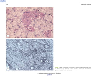 794 Patología especial
FIGURA 23-42. Enfermedad de Gaucher. a) Hígado con acumulación de mate-
rial PAS positivo en células de Kupffer. b) Con el microscopio electrónico se
aprecia el carácter fibrilar del material.
(a)
(b)
© 2007 Editorial Médica Panamericana, S.A de C.V.
Cisfarm
 