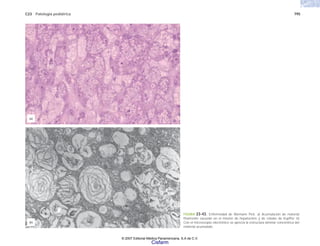 C23 Patología pediátrica 795
FIGURA 23-43. Enfermedad de Niemann Pick. a) Acumulación de material
finamente vacuolar en el interior de hepatocitos y de células de Kupffer. b)
Con el microscopio electrónico se aprecia la estructura laminar concéntrica del
material acumulado.
(a)
(b)
© 2007 Editorial Médica Panamericana, S.A de C.V.
Cisfarm
 