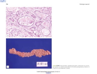 796 Patología especial
FIGURA 23-44. Mucoviscidosis. patología pancreática. a) Retención de secrecio-
nes espesas en conductos pancreáticos con atrofia parenquimatosa y fibrosis. b)
El páncreas está adelgazado y nodular.
(a)
(b)
© 2007 Editorial Médica Panamericana, S.A de C.V.
Cisfarm
 