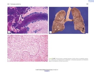 C23 Patología pediátrica 797
FIGURA 23-45. Mucoviscidosis. patología pulmonar. a) Moco denso en glándulas traquea-
les. b) Abscesos y bronquiectasias en pulmones. c) Neumonía purulenta con inflamación
aguda en bronquiolos y alveolos pulmonares.
(a) (b)
(c)
© 2007 Editorial Médica Panamericana, S.A de C.V.
Cisfarm
 