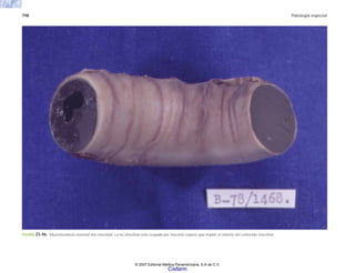 798 Patología especial
FIGURA 23-46. Mucoviscidosis neonatal ileo meconial. La luz intestinal está ocupada por meconio espeso que impide el tránsito del contenido intestinal.
© 2007 Editorial Médica Panamericana, S.A de C.V.
Cisfarm
 