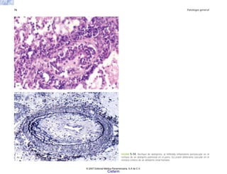 76 Patología general
FIGURA 5-14. Rechazo de aloinjertos. a) Infiltrado inflamatorio perivascular en el
rechazo de un aloinjerto pulmonar en el perro. b) Lesión obliterante vascular en el
rechazo crónico de un aloinjerto renal humano.
(a)
(b)
© 2007 Editorial Médica Panamericana, S.A de C.V.
Cisfarm
 