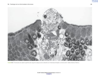 C6 Patología de las enfermedades infecciosas 83
FIGURA 6-3. Penetración del epitelio superficial del ciego del cobayo por dos trofozoítos de Entamoeba histolytica. (Cortesía del Dr. Adolfo Martínez Palomo.)
© 2007 Editorial Médica Panamericana, S.A de C.V.
Cisfarm
 