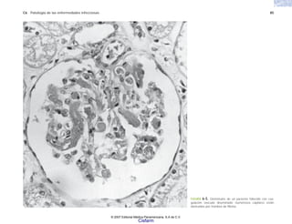 C6 Patología de las enfermedades infecciosas 85
FIGURA 6-5. Glomérulos de un paciente fallecido con coa-
gulación vascular diseminada; numerosos capilares están
obstruidos por trombos de fibrina.
© 2007 Editorial Médica Panamericana, S.A de C.V.
Cisfarm
 