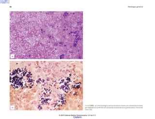 86 Patología general
FIGURA 6-6. a)Cortehistológicoconneumoníanecrosanteconcoloniasbacterianas
porStaphylococcusHElOX.b)Coloniasbacterianasdecocosgrampositivos.Tinciónde
Gram 40x.
(b)
(a)
© 2007 Editorial Médica Panamericana, S.A de C.V.
Cisfarm
 