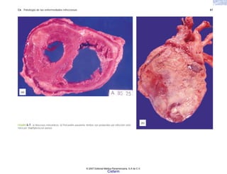 C6 Patología de las enfermedades infecciosas 87
FIGURA 6-7. a) Abscesos miocárdicos. b) Pericarditis purulenta. Ambos son producidos por infección sisté-
mica por Staphylococcus aureus.
(a)
(b)
© 2007 Editorial Médica Panamericana, S.A de C.V.
Cisfarm
 