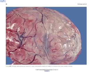 88 Patología general
FIGURA 6-8. Meningitis aguda purulenta por neumococo. Espacio subaracnoideo ocupado por exudado con trombosis de las venas cerebrales corticales.
© 2007 Editorial Médica Panamericana, S.A de C.V.
Cisfarm
 