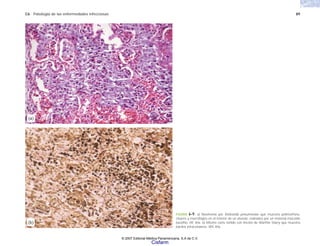 C6 Patología de las enfermedades infecciosas 89
FIGURA 6-9. a) Neumonía por Klebsiella pneumoniae que muestra polimorfonu-
cleares y macrófagos en el interior de un alveolo, rodeados por un material mucoide
basófilo. HE 40x. b) Mismo corte teñido con tinción de Warthin Starry que muestra
bacilos intracelulares. WS 40x.
(b)
(a)
© 2007 Editorial Médica Panamericana, S.A de C.V.
Cisfarm
 