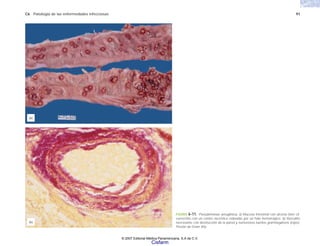 C6 Patología de las enfermedades infecciosas 91
FIGURA 6-11. Pseudomonas aeruginosa. a) Mucosa intestinal con úlceras bien cir-
cunscritas con un centro necrótico rodeadas por un halo hemorrágico. b) Vasculitis
necrosante con destrucción de la pared y numerosos bacilos gramnegativos (rojos).
Tinción de Gram 40x.
(b)
(a)
© 2007 Editorial Médica Panamericana, S.A de C.V.
Cisfarm
 