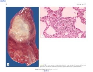92 Patología general
FIGURA 6-12. a) Lesión gomosa en el parénquima pulmonar en un caso de sífilis neonatal. b) Neumonía
luética en un caso de sífilis congénita con infiltrados nodulares de linfocitos y células plasmáticas.
(b)
(a)
© 2007 Editorial Médica Panamericana, S.A de C.V.
Cisfarm
 