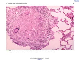 C6 Patología de las enfermedades infecciosas 93
FIGURA 6-13. Granuloma tuberculoso con necrosis central rodeada de células epiteloides en empalizada y células gigantes multinucleadas.
© 2007 Editorial Médica Panamericana, S.A de C.V.
Cisfarm
 