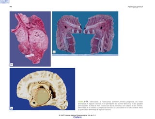 94 Patología general
FIGURA 6-14. Tuberculosis. a) Tuberculosis pulmonar primaria progresiva con lesión
destructiva de aspecto caseoso en el parénquima del pulmón derecho y en los ganglios
peritraqueales. b) Mal de Pott. Destrucción de las vértebras con colapso de las mismas,
deformidad de la columna y compresión medular. c) Tuberculoma en el tallo cerebral. Masa
ocupativa bien delimitada de aspecto caseoso.
(b)
(c)
(a)
© 2007 Editorial Médica Panamericana, S.A de C.V.
Cisfarm
 
