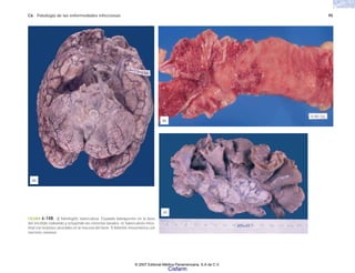 C6 Patología de las enfermedades infecciosas 95
(d)
(f)
(e)
FIGURA 6-14B. d) Meningitis tuberculosa. Exudado blanquecino en la base
del encéfalo rodeando y ocluyendo las cisternas basales. e) Tuberculosis intes-
tinal con lesiones ulceradas en la mucosa del ileon. f) Adenitis mesentérica con
necrosis caseosa.
© 2007 Editorial Médica Panamericana, S.A de C.V.
Cisfarm
 