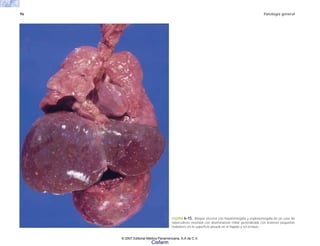 96 Patología general
FIGURA 6-15. Bloque visceral con hepatomegalia y esplenomegalia de un caso de
tuberculosis neonatal con diseminación miliar generalizada con lesiones pequeñas
nodulares en la superficie pleural en el hígado y en el bazo.
© 2007 Editorial Médica Panamericana, S.A de C.V.
Cisfarm
 