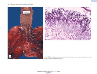 C6 Patología de las enfermedades infecciosas 97
FIGURA 6-16. a) Candidiasis esofágica superficial con extensa necrosis. b) Numerosas levaduras inva-
diendo el espesor de la mucosa. PASlOx.
(b)
(a)
© 2007 Editorial Médica Panamericana, S.A de C.V.
Cisfarm
 