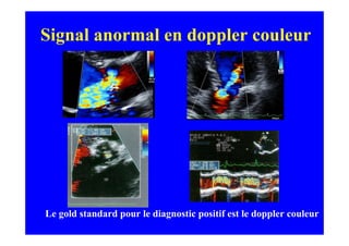 Signal anormal en doppler couleur




Le gold standard pour le diagnostic positif est le doppler couleur
 