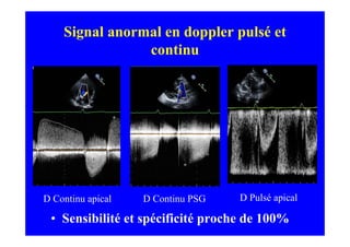 Signal anormal en doppler pulsé et
                continu




D Continu apical   D Continu PSG   D Pulsé apical

 • Sensibilité et spécificité proche de 100%
 