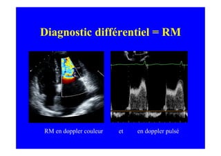 Diagnostic différentiel = RM




RM en doppler couleur   et   en doppler pulsé
 