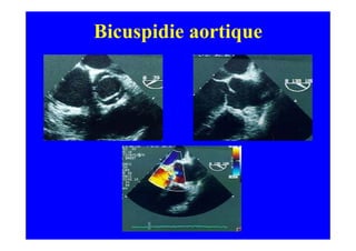 Bicuspidie aortique
 