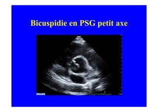 Bicuspidie en PSG petit axe
 