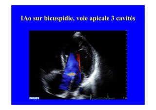 IAo sur bicuspidie, voie apicale 3 cavités
 