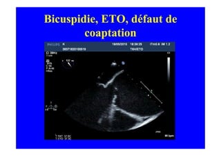 Bicuspidie, ETO, défaut de
        coaptation
 