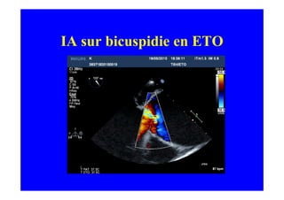 IA sur bicuspidie en ETO
 