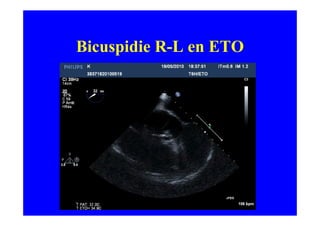Bicuspidie R-L en ETO
 