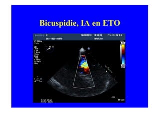 Bicuspidie, IA en ETO
 