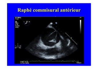 Raphé commisural antérieur
 