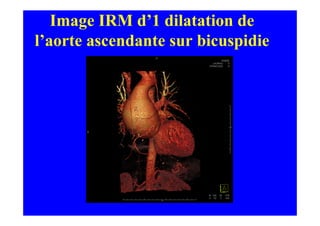 Image IRM d’1 dilatation de
l’aorte ascendante sur bicuspidie
 