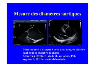 Mesure des diamètres aortiques




    Mesures bord d’attaque à bord d’attaque, en diastole
    sauf pour la chambre de chasse
    Mesures à effectuer : ch de ch, valsalvas, JST,
    segment I, II III et aorte abdominale
 