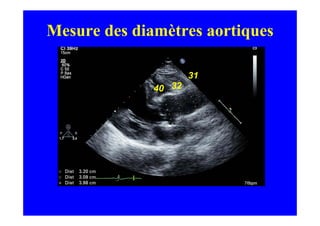 Mesure des diamètres aortiques

                      31
              40 32
 
