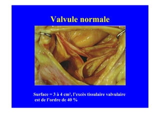 Valvule normale




Surface = 3 à 4 cm², l’excès tissulaire valvulaire
est de l’ordre de 40 %
 