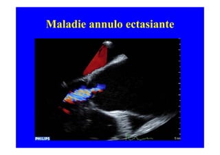 Maladie annulo ectasiante
 