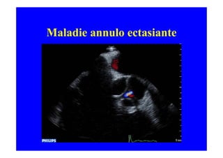 Maladie annulo ectasiante
 