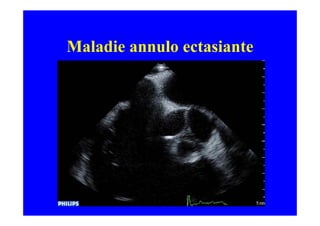 Maladie annulo ectasiante
 