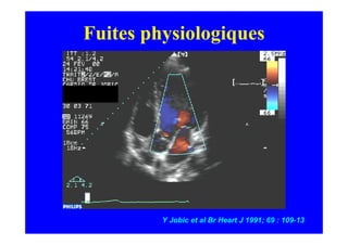 Fuites physiologiques




         Y Jobic et al Br Heart J 1991; 69 : 109-13
 