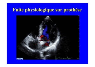 Fuite physiologique sur prothèse
 