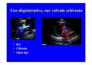 IAo dégénérative, sur valvule sclérosée




 • RA
 • I Rénale
 • Sujet âgé
 